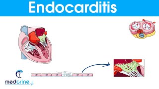 Endocarditis  causes symptoms pathophysiology diagnosis and treatment [upl. by Warthman]