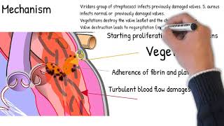 Infective Endocarditis  simply explained Symptoms signs causes [upl. by Otha]