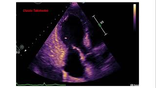 Cardiomyopathy Causes amp Symptoms  Cardiology🫀 [upl. by Anilek]