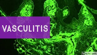 Granulomatosis with Polyangiitis pathophysiology symptoms treatment [upl. by Mccandless]