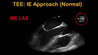 Transesophageal Echocardiography Infective Endocarditis [upl. by Gnuh]