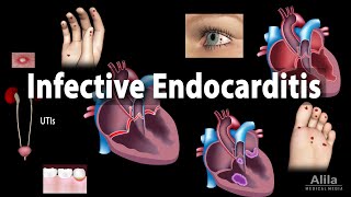 Infective Endocarditis Animation [upl. by Meagher544]