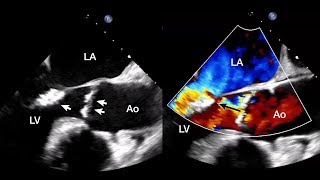 Aortic and Mitral Valve Endocarditis Due to Austin Flint Phenomenon [upl. by Akitnahs]