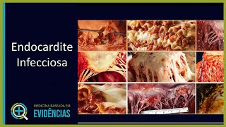 Endocardite Infecciosa  Aula [upl. by Enenaj655]