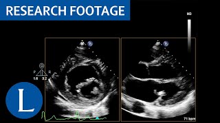 Mass attached to base of the posterior leaflet of the mitral LibmanSacks endocarditis 2 of 4 [upl. by Kopple]